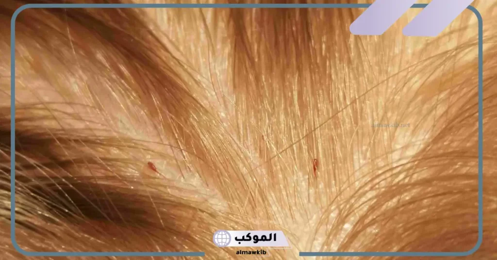 رؤية القمل في الشعر في المنام للعزباء