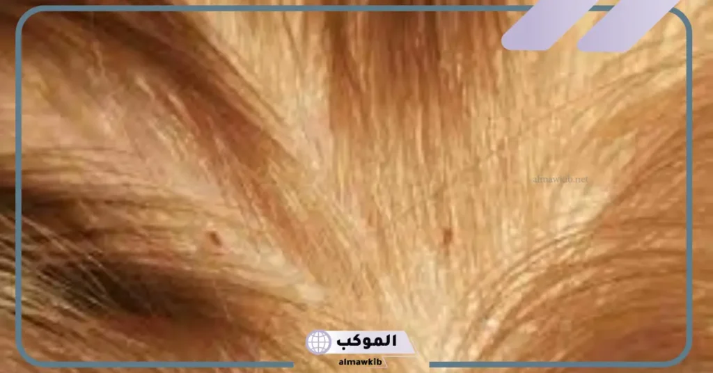 القمل في المنام في الشعر للمطلقة