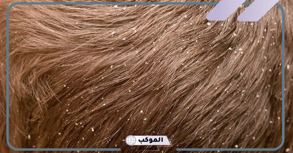 الحلم بالقمل في الشعر للمطلقة