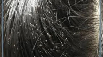 حلم القمل للحامل