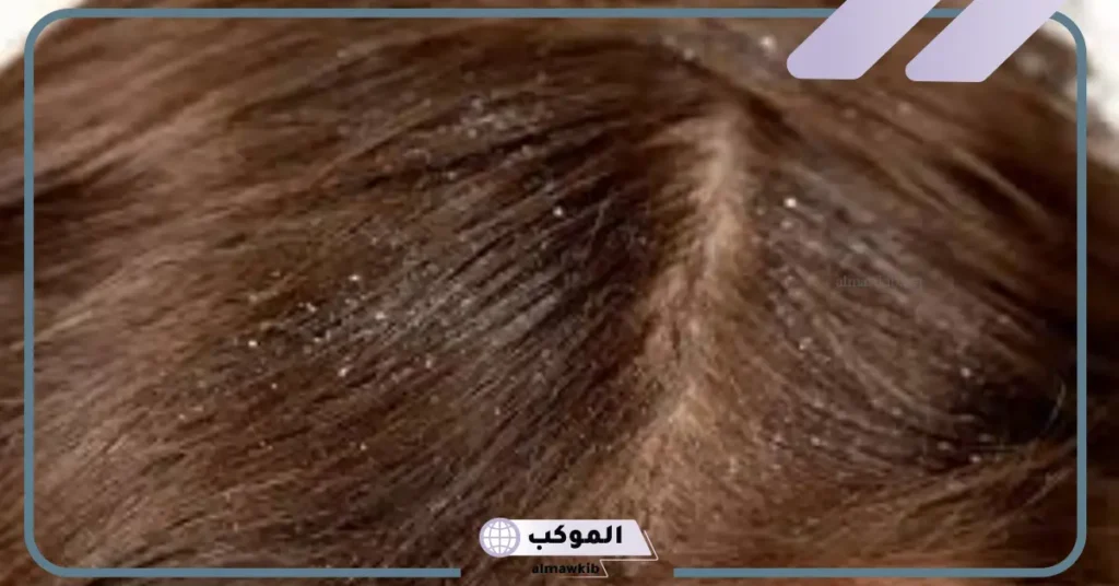 تفسير الحلم بالقمل بالشعر في المنام للرجل والمرأة العزباء 6 تفسير حلم نزع القمل من الشعر وقتله للمتزوجة