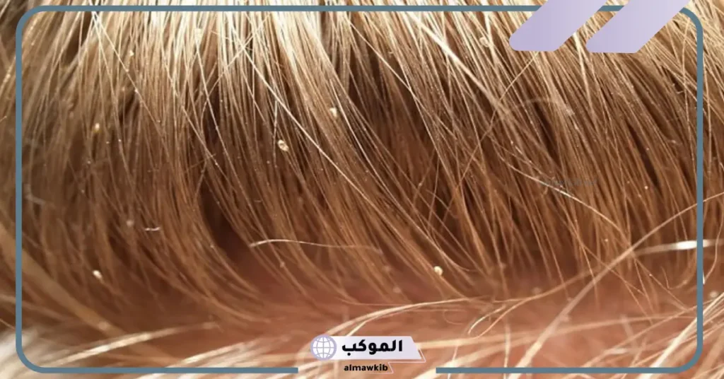 تفسير حلم القمل في الشعر وقتله للمتزوجة