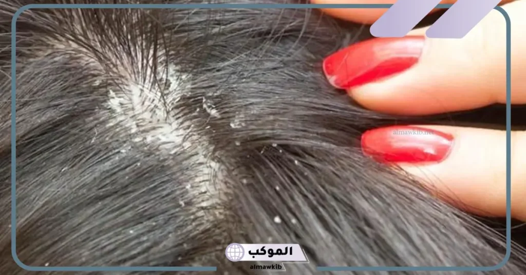 رؤية القمل في الشعر في المنام للمتزوجة