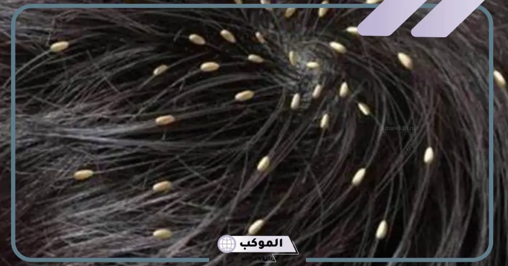 رؤية القمل في الشعر في المنام للعزباء