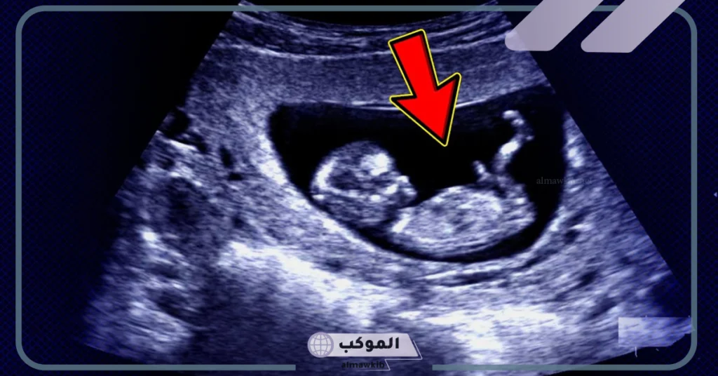 شكل الجنين في الشهر الثالث بالسونار