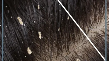 حلم قمل كبير