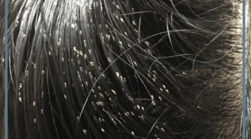 قمل اسود للعزباء