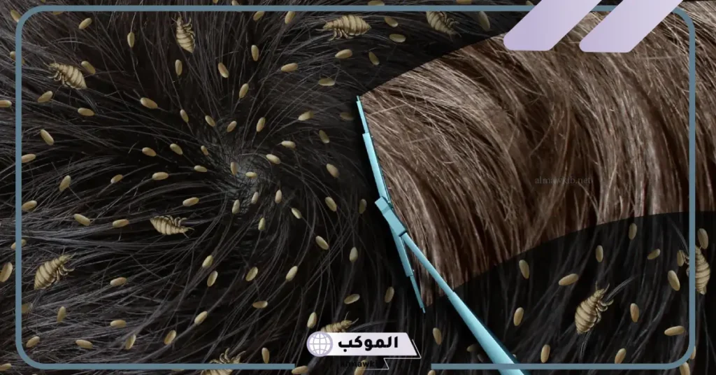 تفسير حلم القمل للمطلقة