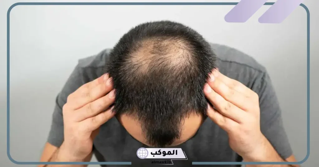 تفسير حلم الصلع في جزء من الرأس للعزباء