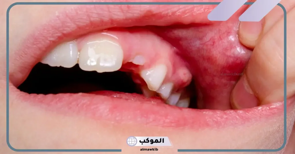 تفسير حلم خلع الضرس بدون ألم للعزباء