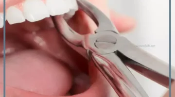 منام خلع السن