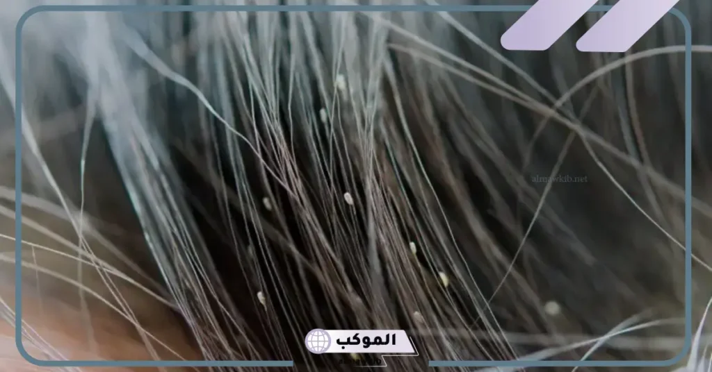 تفسير القمل في الشعر للمرأة الحامل والمطلقة والمتزوجة لابن سيرين 6 تفسير حلم القمل الأسود في الشعر للمتزوجة وقتله